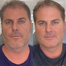 Jawline and chin filler for men in Maidenhead